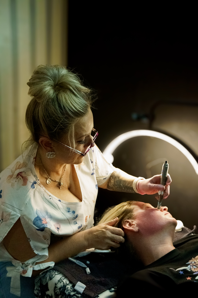 Microneedling