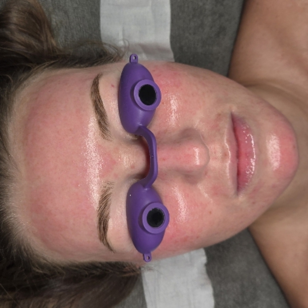 Microneedling at CareBeautyDerm in Smithtown, NY