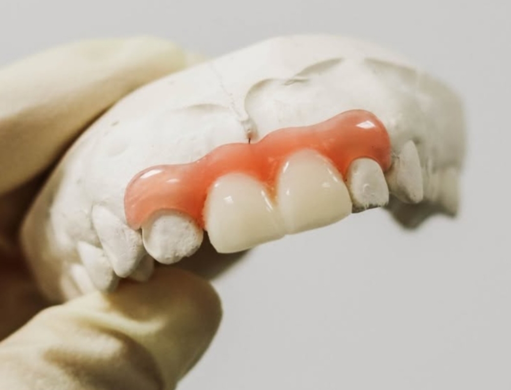 Custom Partial Denture