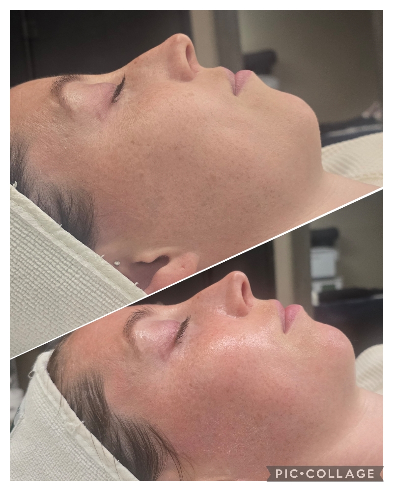 Liquid Microneedling