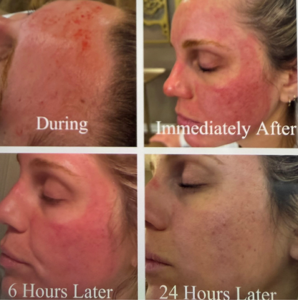 Microneedling With Biosomes