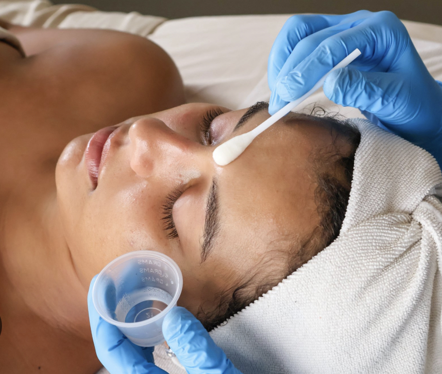 Chemical Peel Treatment