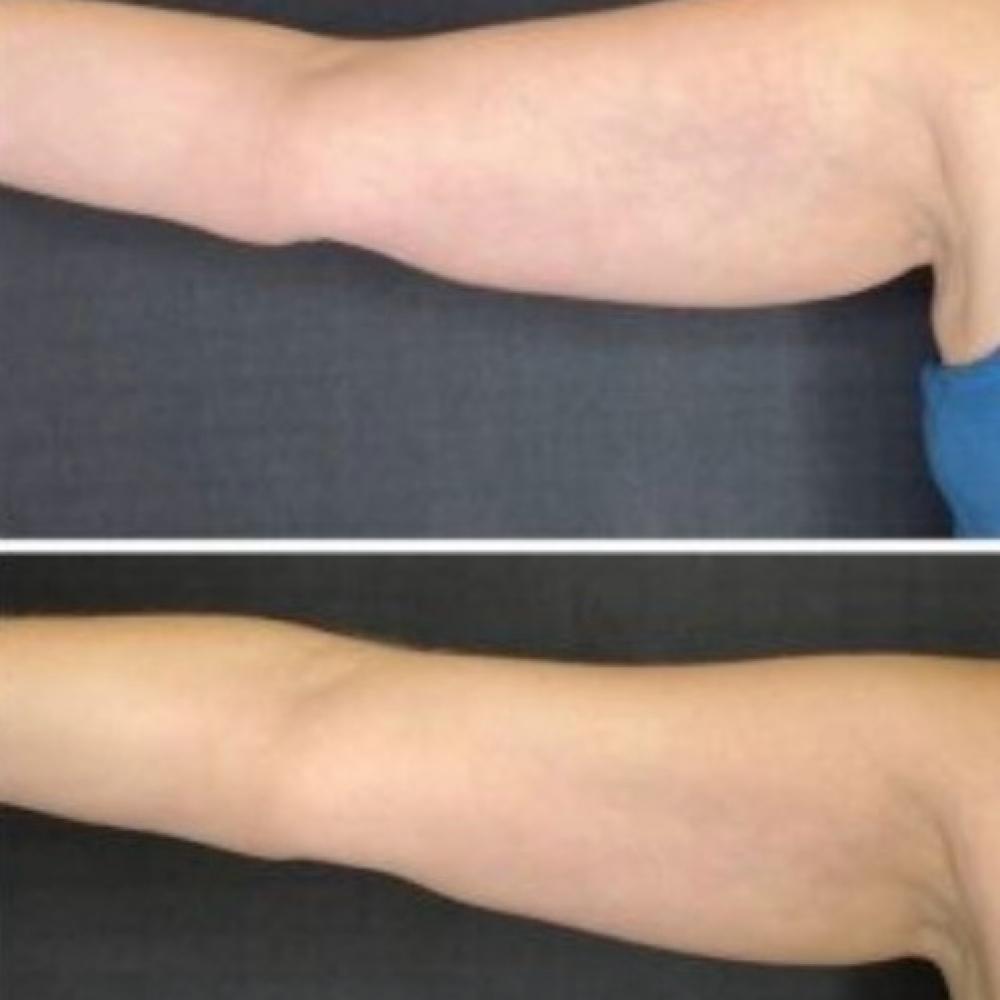 PCDC (Lipo Dissolve) at Timeless by Edie in Hebbronville, TX