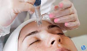 The Microneedling Facial