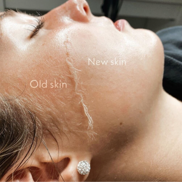 Dermaplane treatment only at PNW BEAUTY in Roseburg, OR