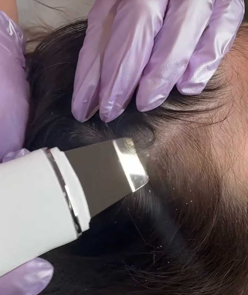 DANDRUFF TREATMENT