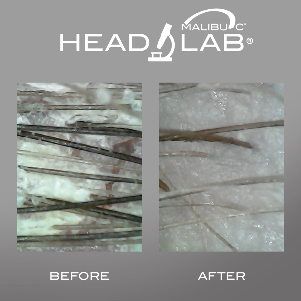 Vitamin C Scalp Treatment