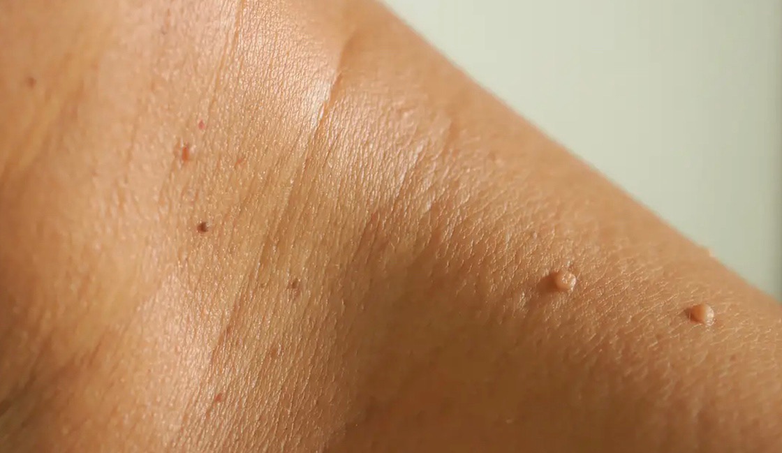 Remove skin tags