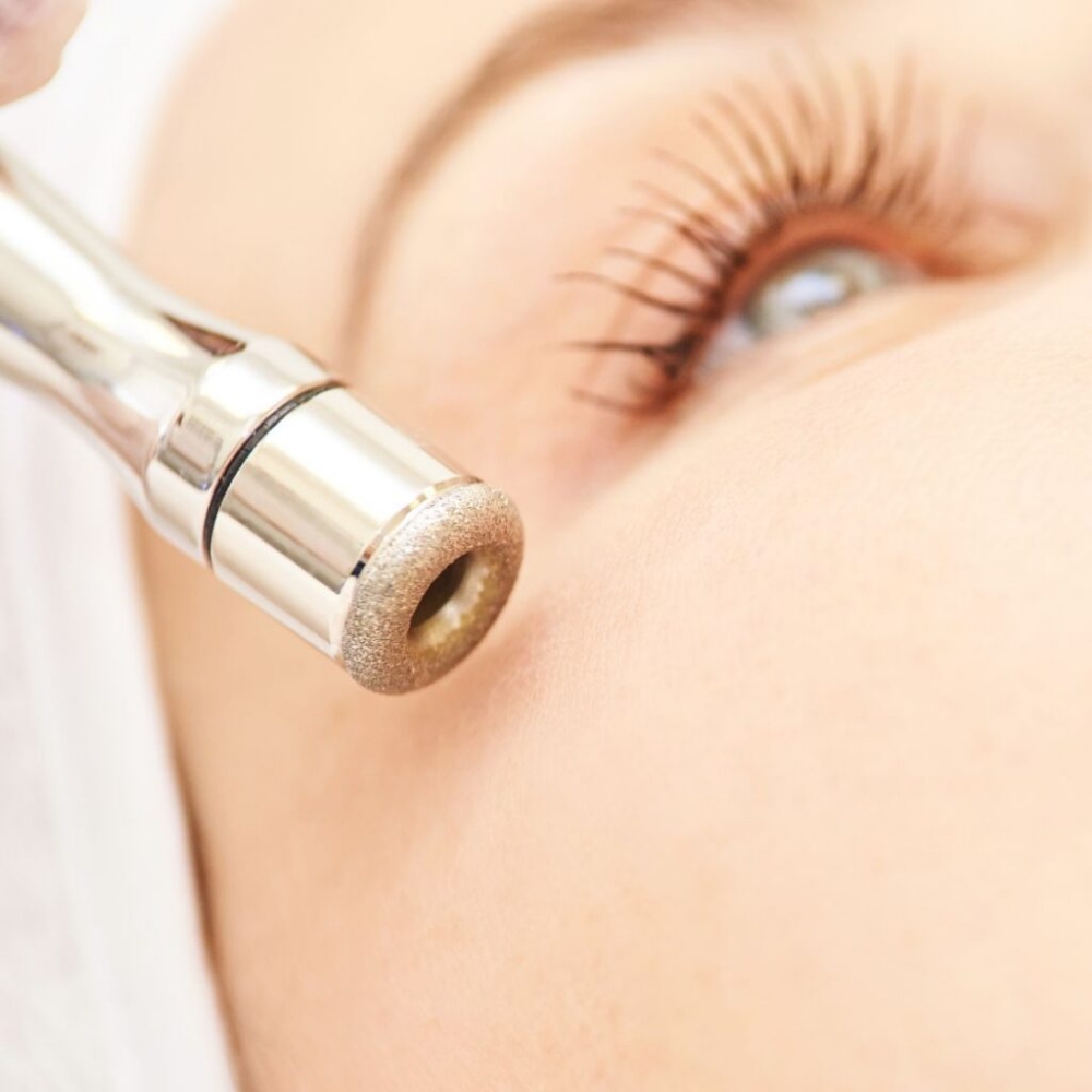Diamond Microdermabrasion Treatment