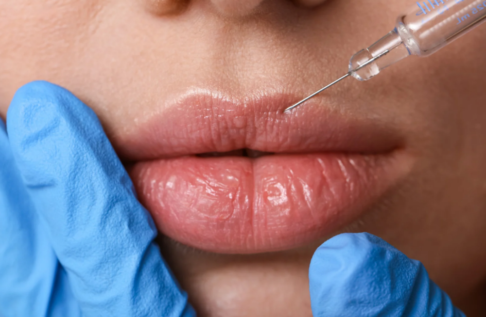 Lip Dissolving Treatment