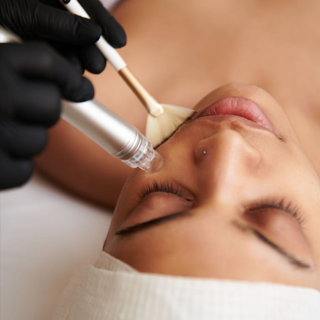 Collagen Induction Full Facial at Radiant Reflections Spa in Moorhead, MN