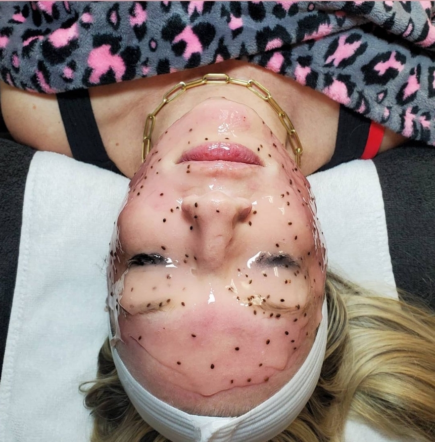 Microdermabrasion Facial