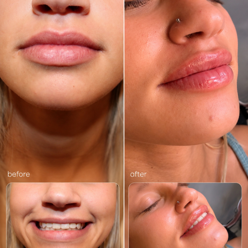 Lip Filler at Skin & Syringe Aesthetics in Rockwall, TX