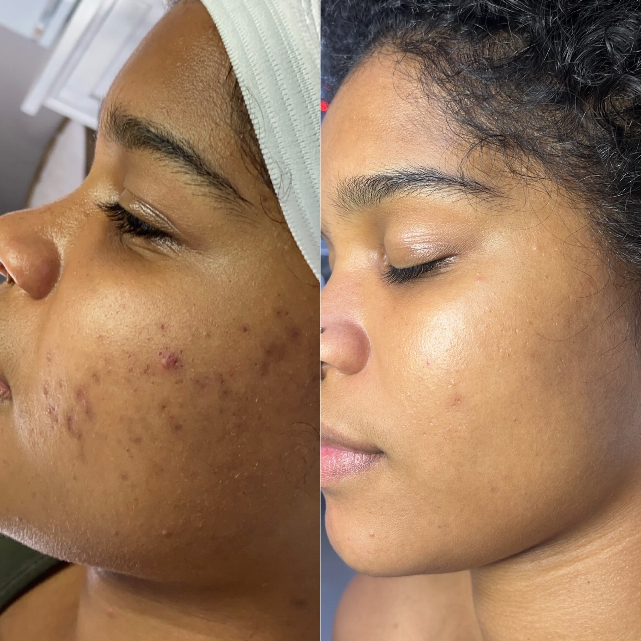 Post Chemical Peel Glow Treatment