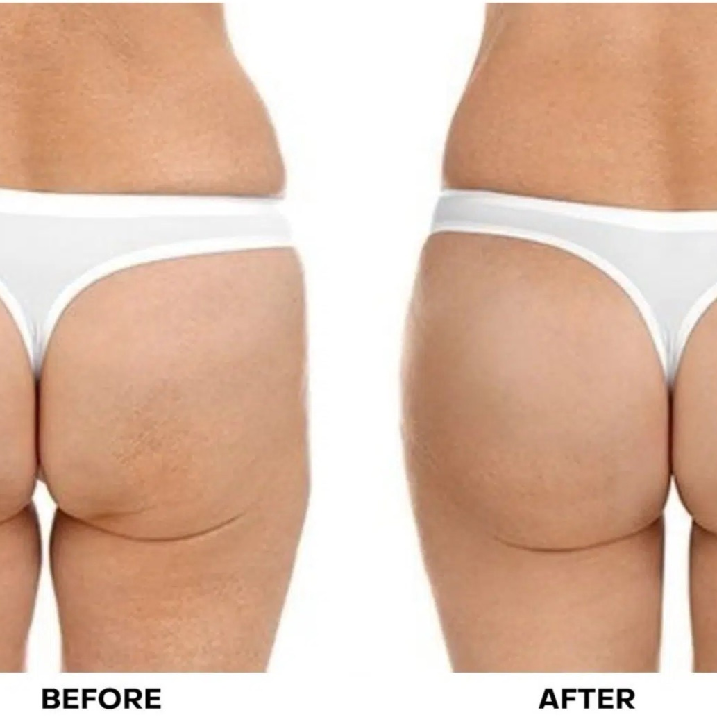 Non-Surgical Booty Lift Special at TBS Collective Wellness in Tulsa, OK