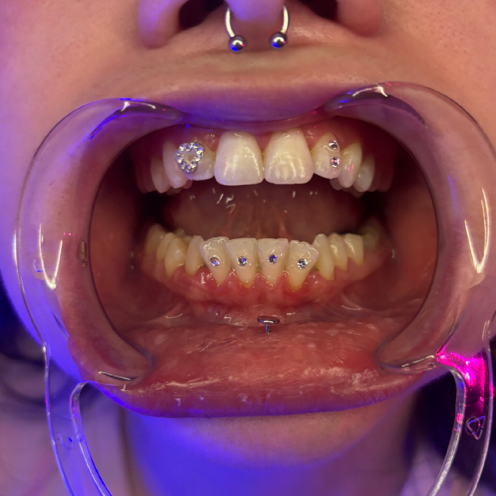 Tooth Gem Decal/Upgraded Gem at Alyssa Rene Esthetics in Lewiston, ID