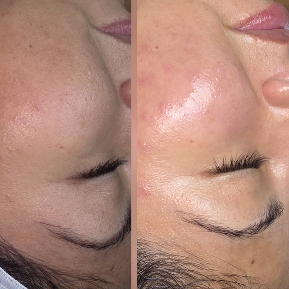 Radiance Resurfacing Facial at Celtic Spa Laser Services in Attleboro, MA