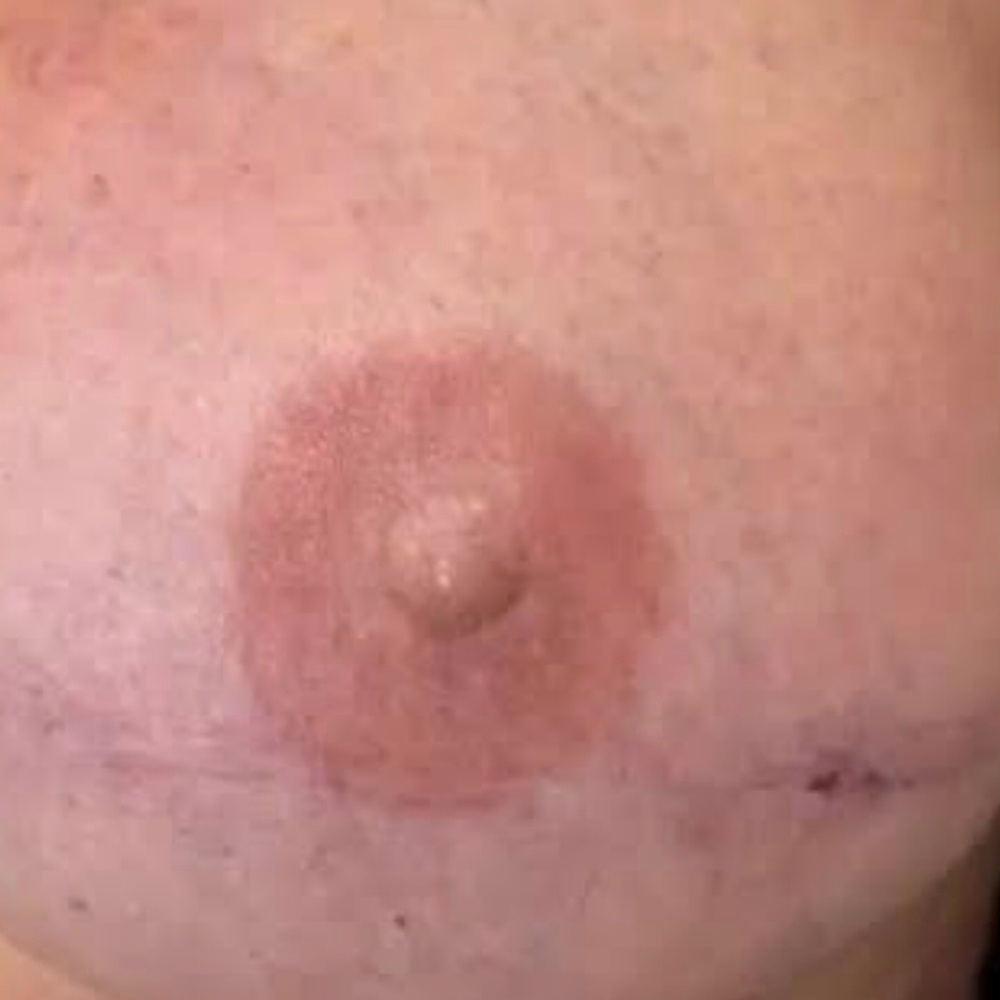Areola 3D Tattoo at Rewind Med Spa in Longmont, CO