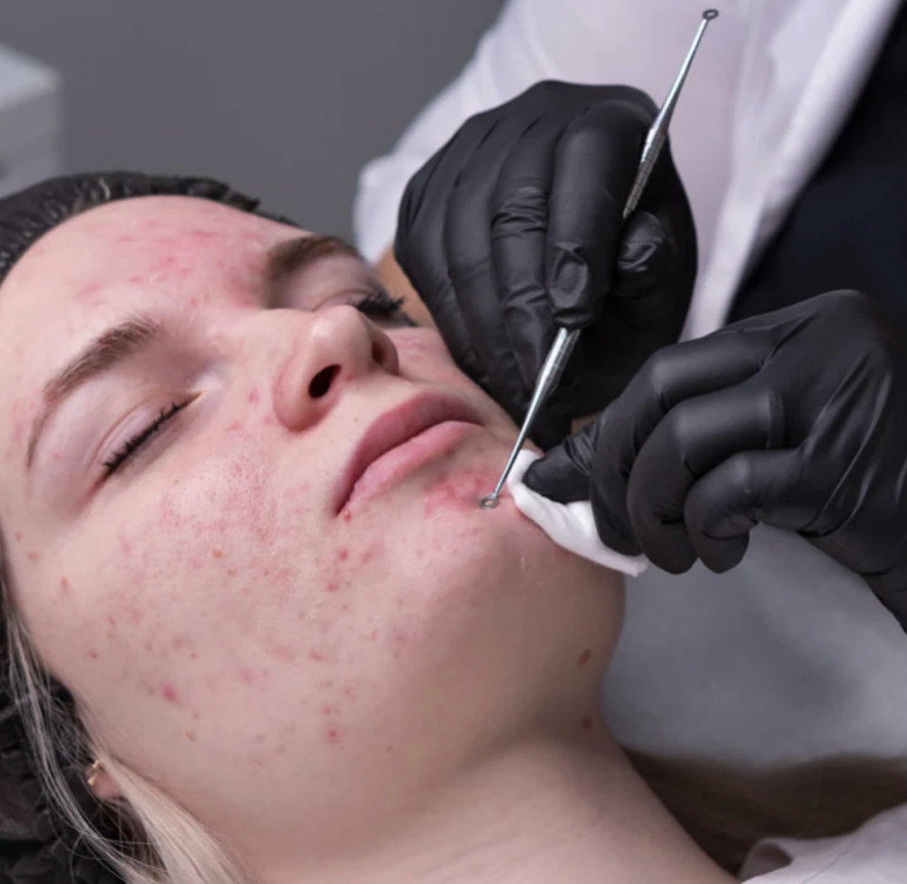 Acne Facial