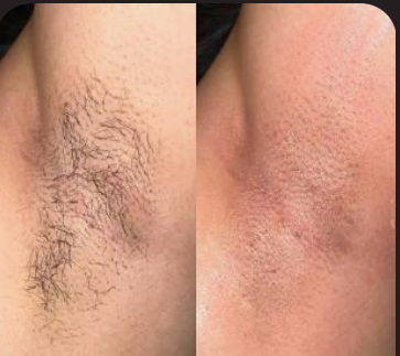 Underarm Wax