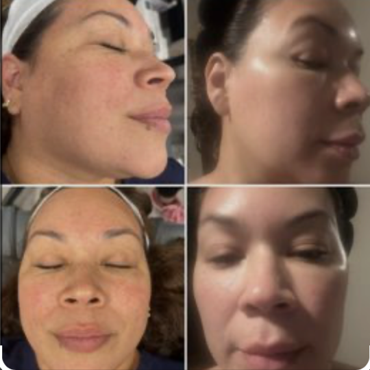 Facial slimming tightening/texture at Glo'Up Body Spa in Atlanta, GA