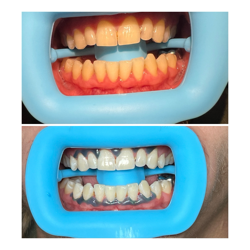 Whitening: 30 Minutes at Simply Snatched in Nevada, MO