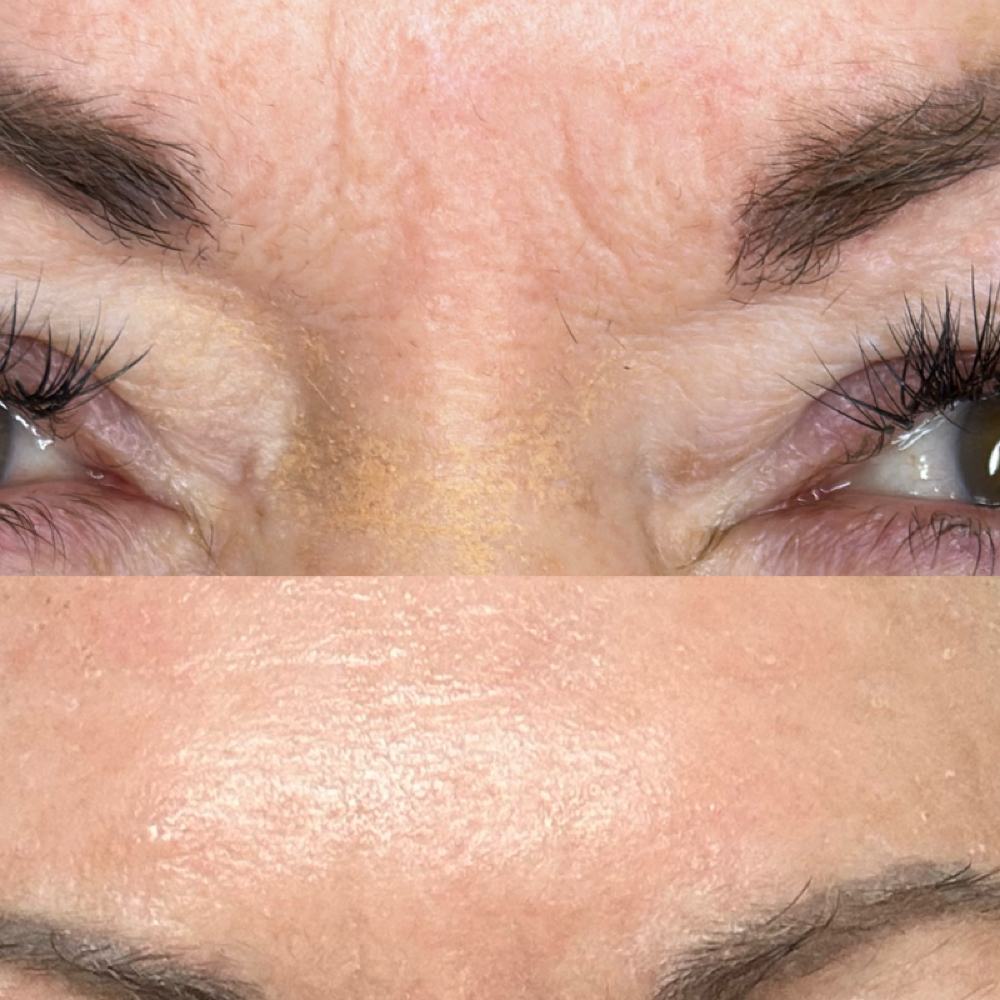 11 O’clocks at Magnolia Plasma Fibroblasting By Mitra in Frisco, TX
