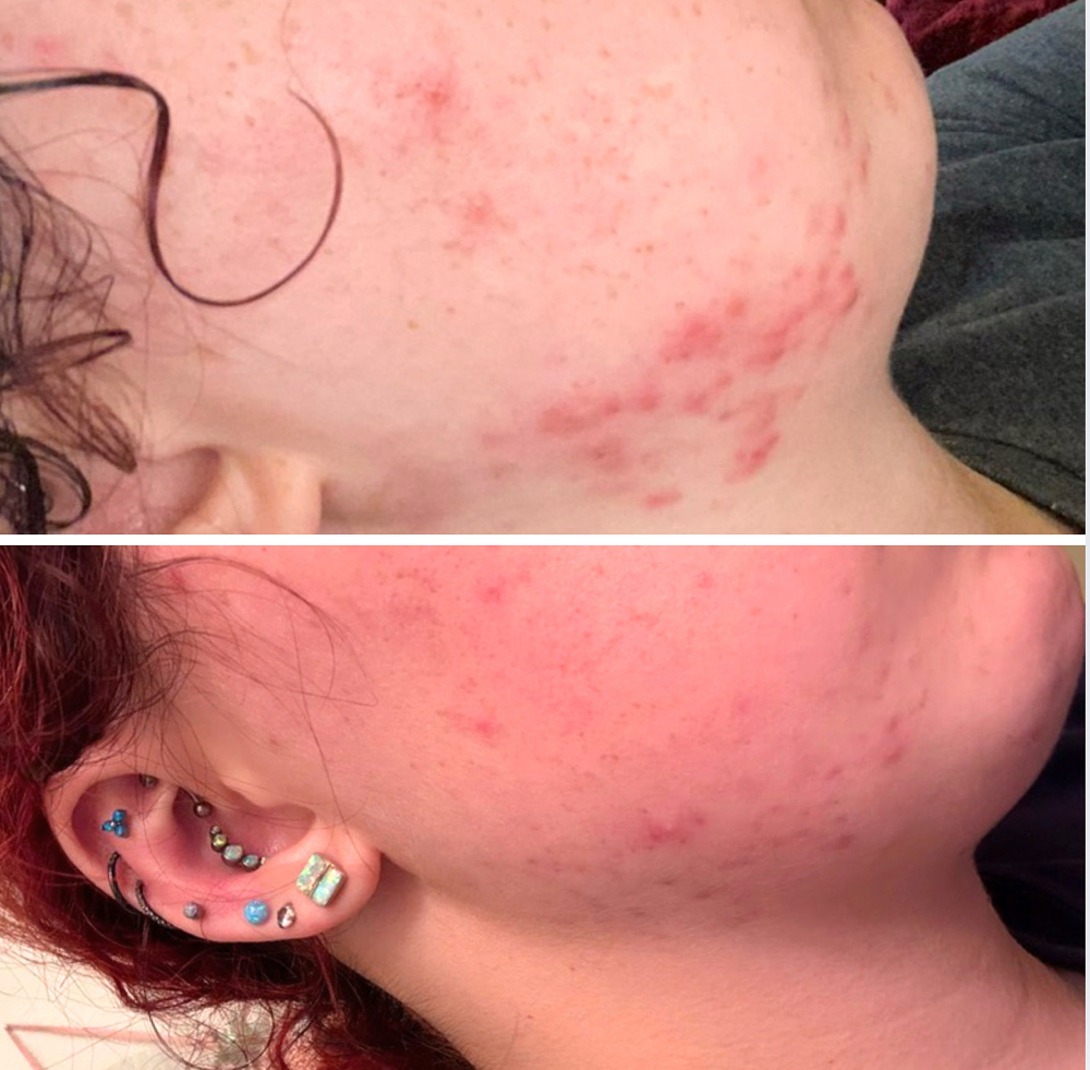 Acne Healing!