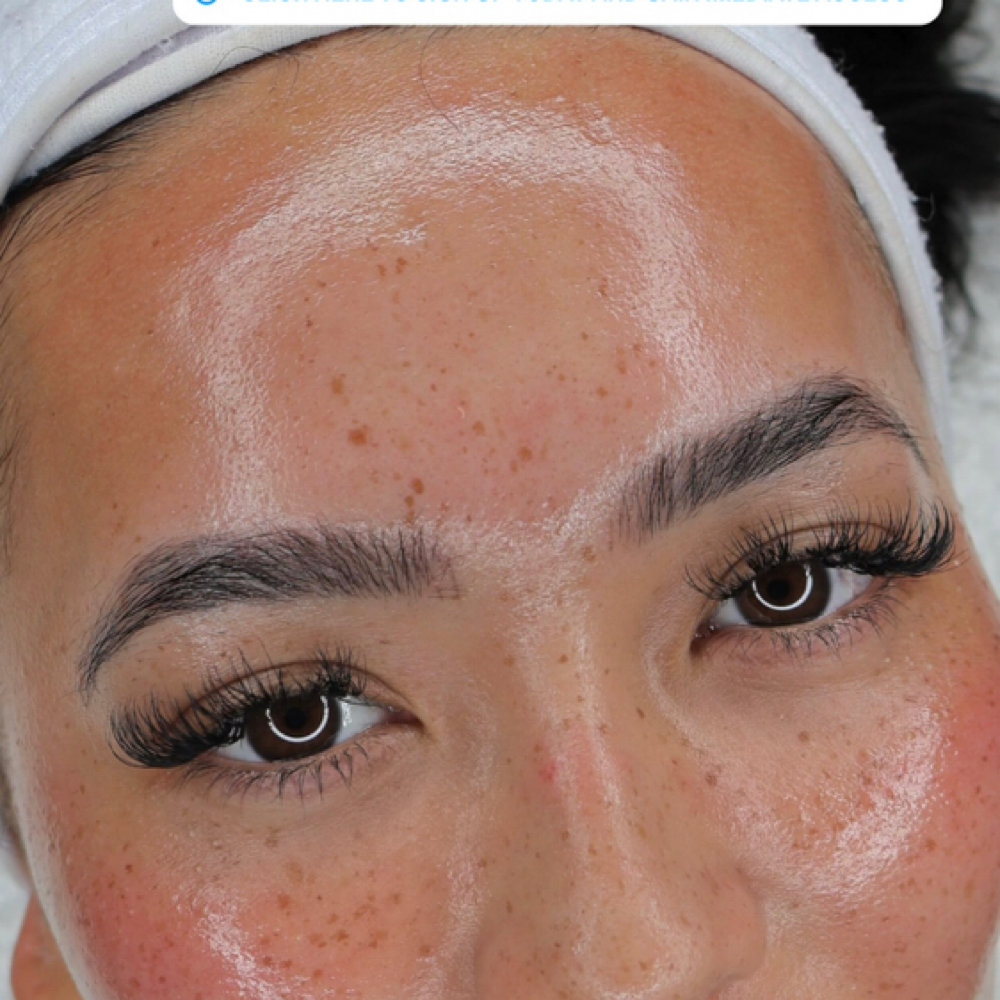 Microneedling at Embassy&health&beauty in Hallandale, FL