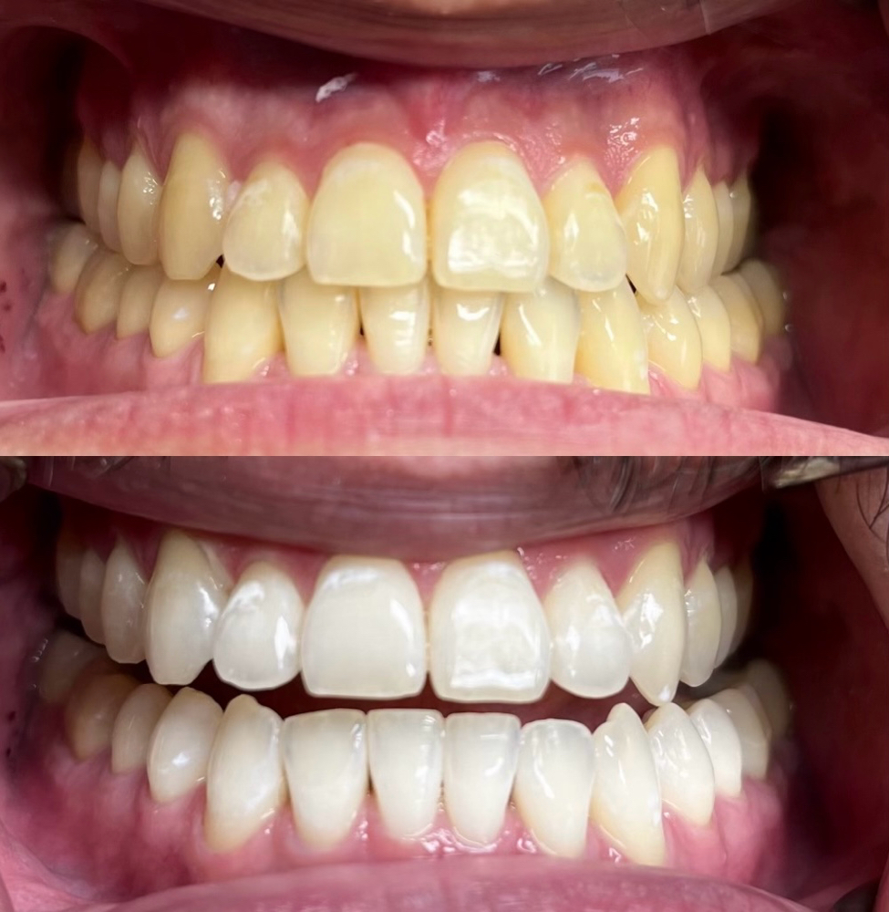 Teeth Whitening