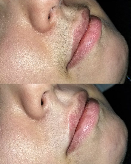 Waxing - Lip and Chin