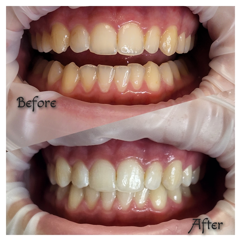 Teeth Whitening 3 Sessions