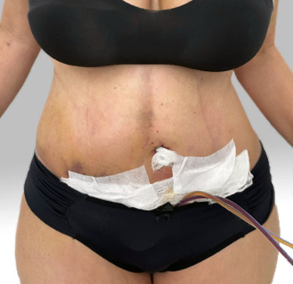 Post Op Lymphatic Massage