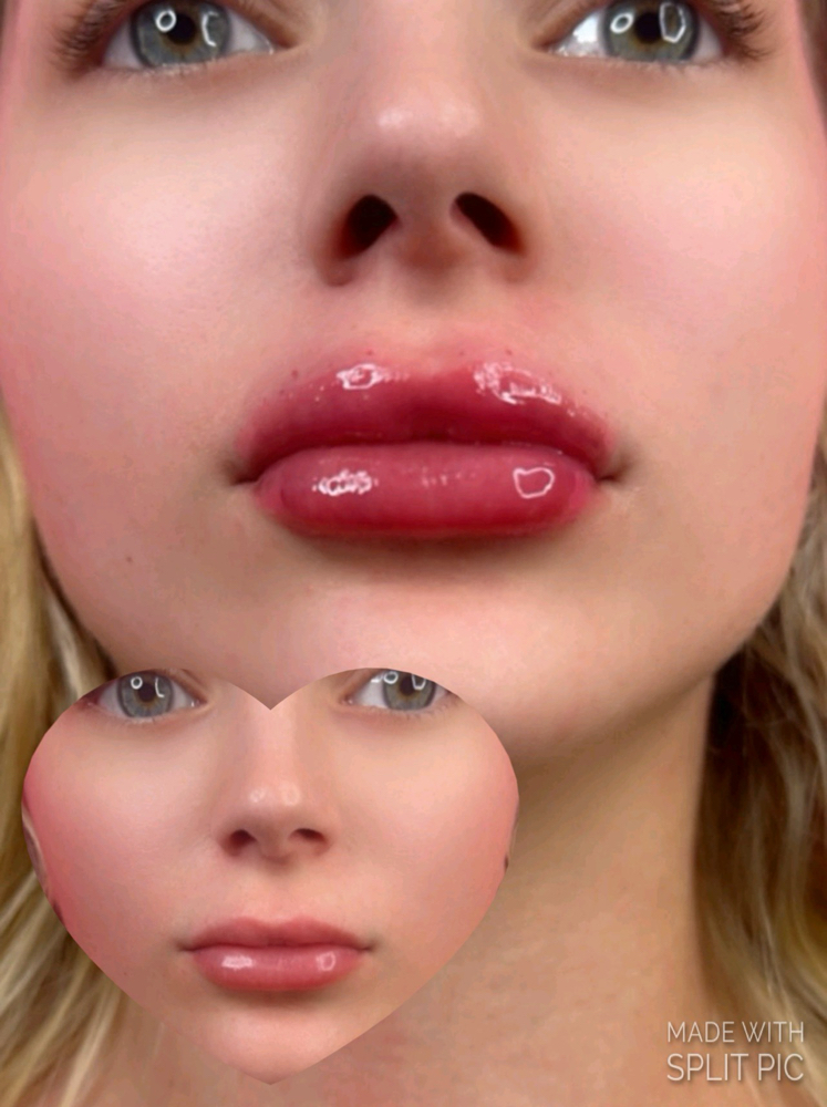 Lip Augmentation 1 💉