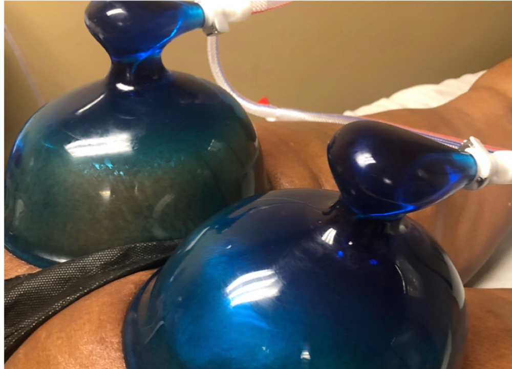 Butt Enhancement