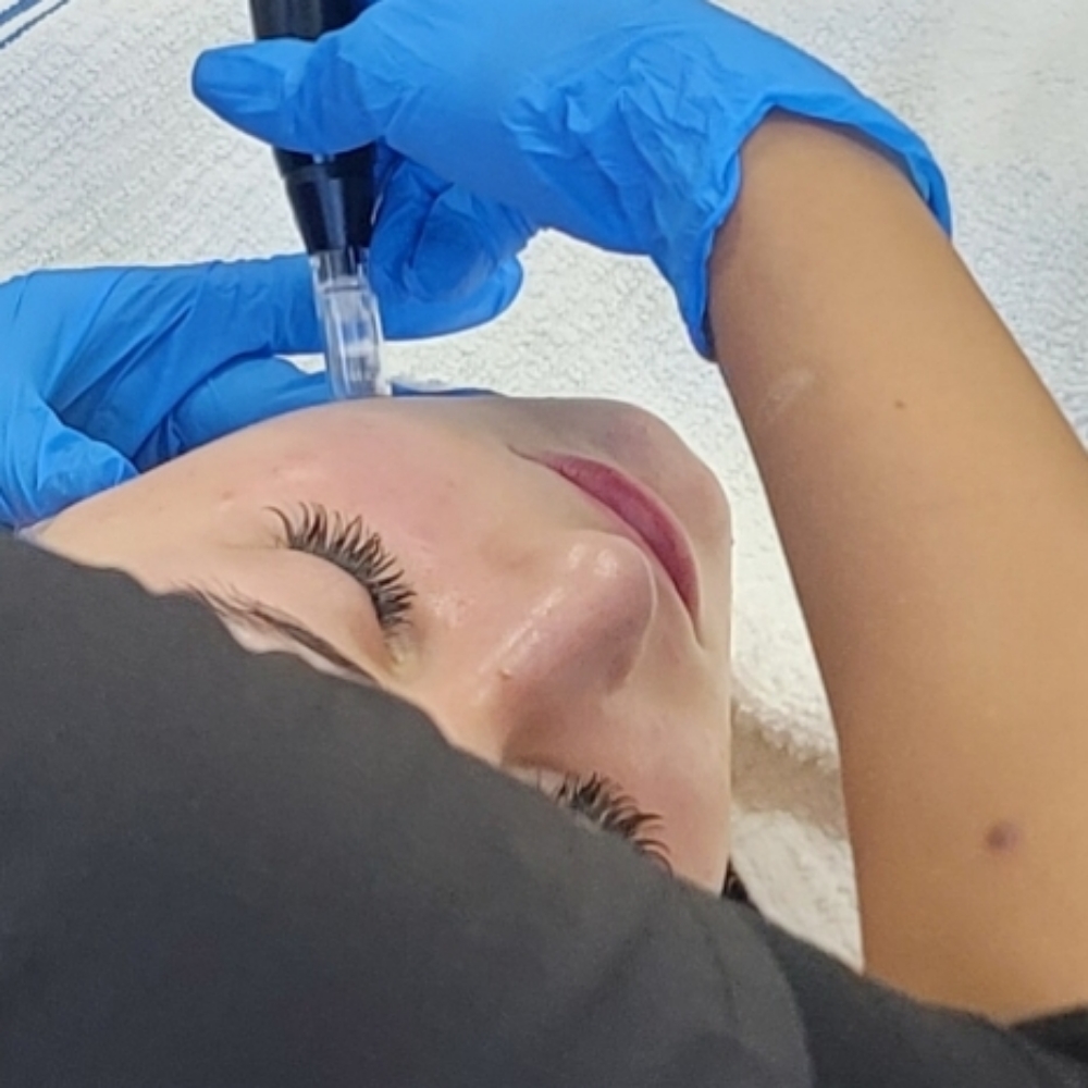 Microneedling at Hello Skin in Charlotte, NC