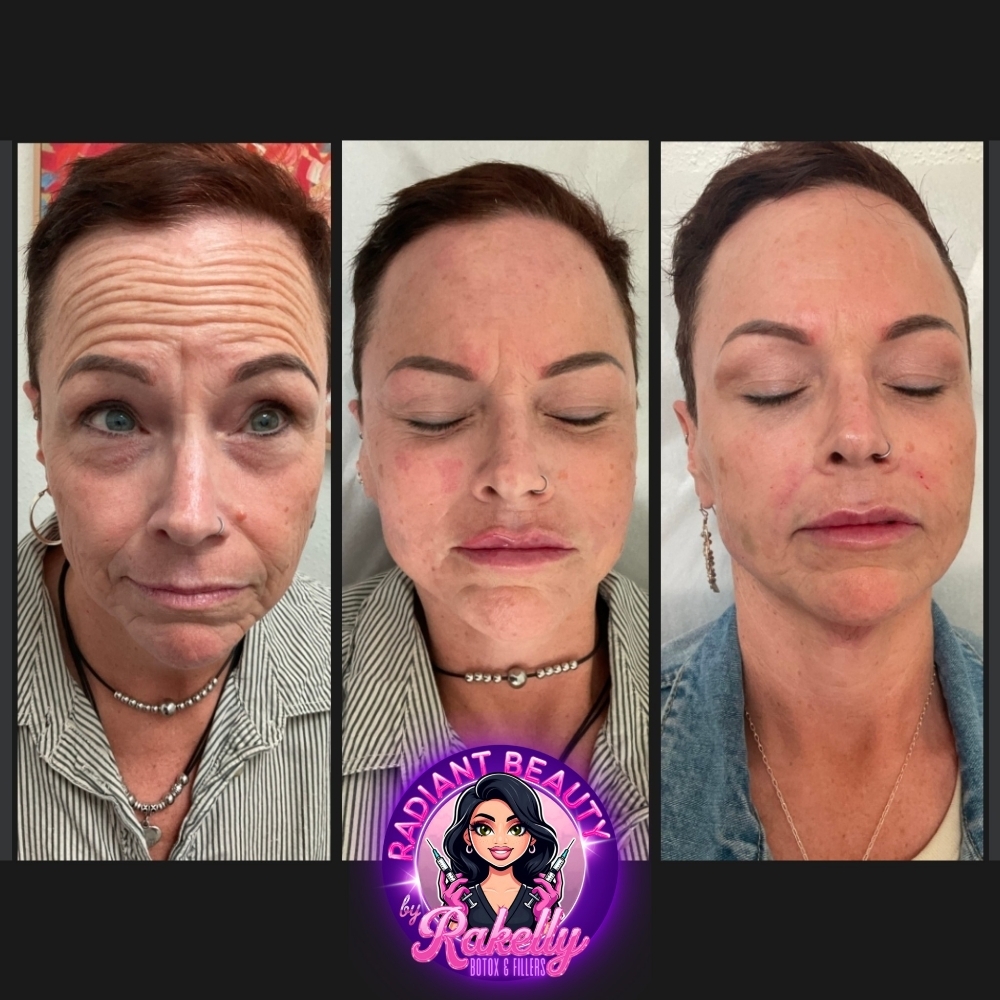 Meso Anti-Aging Treatment at Radiant Beauty By Rakelly LLC in Fort Worth, TX