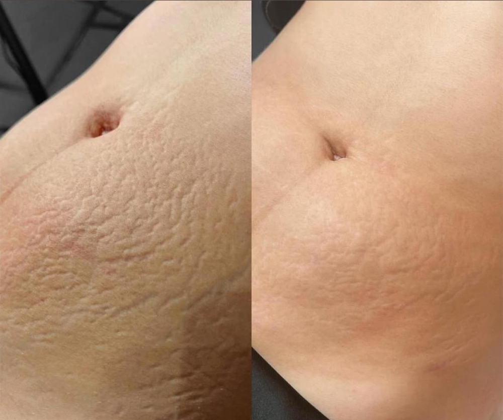 Stretch Marks Reduction/ Estrias