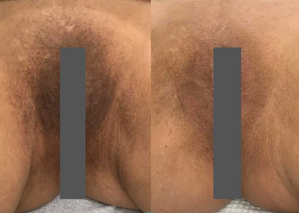 Skin Lightening 3 Sessions Medium A