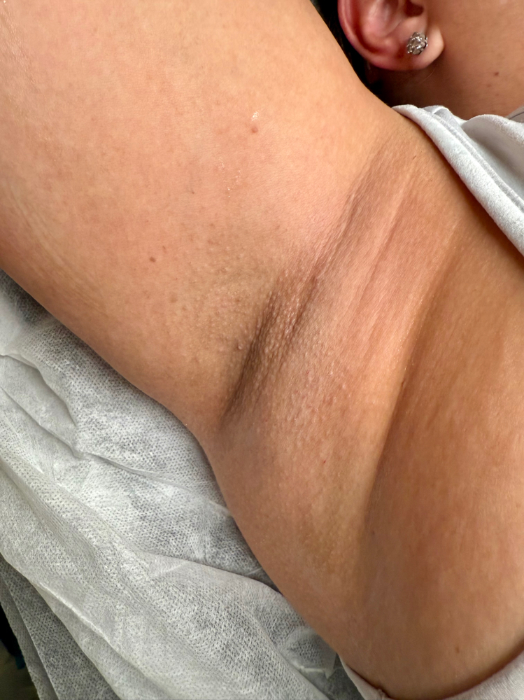 Underarm