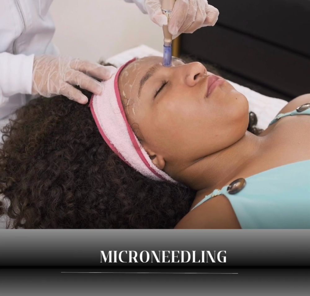 Microneedling With PRP
