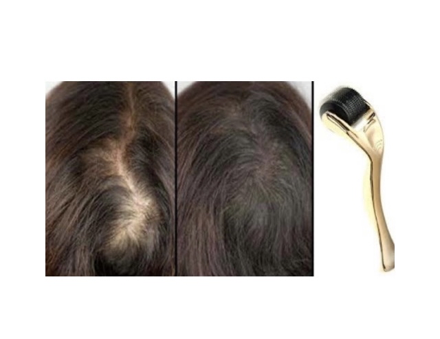 Scalp Dermarolling Treatment