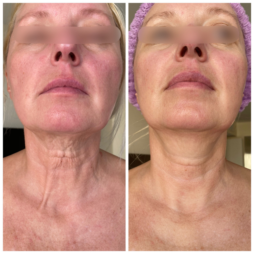 RF skin tightening Face+Neck
