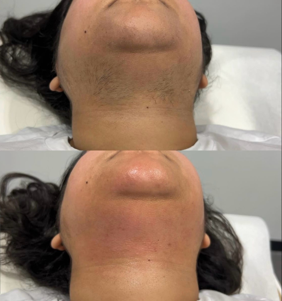 Chin Wax