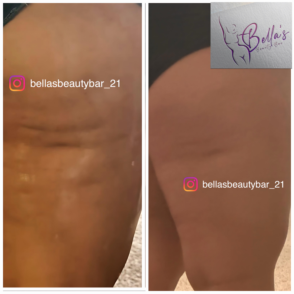 Bella's Cellulite Reduction