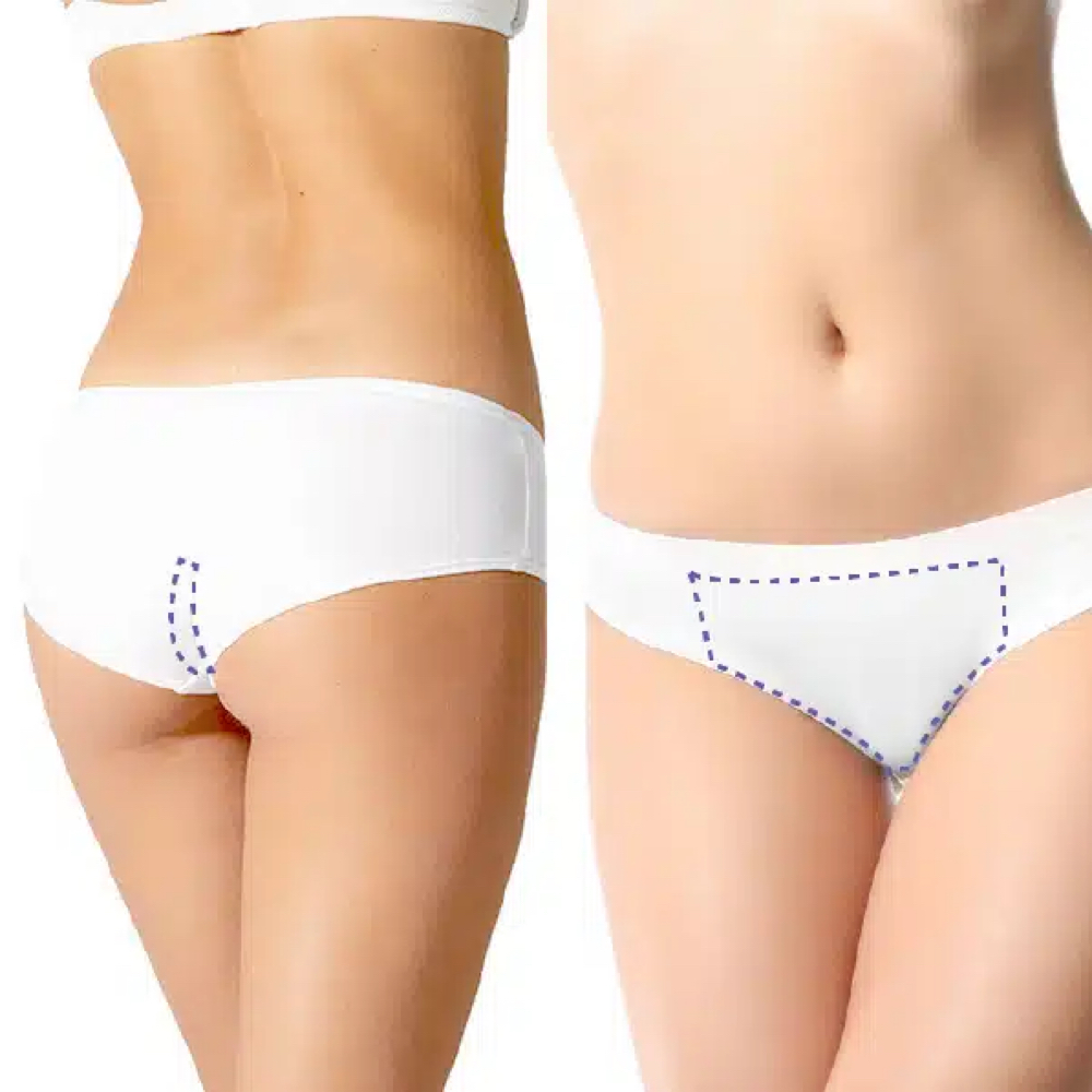DIODO LASER (PERIANAL & Bikini) at Diana Bella LLC in Deerfield Beach, FL