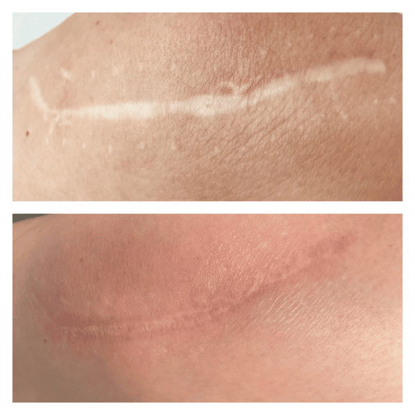 Microneedling- Small Scar