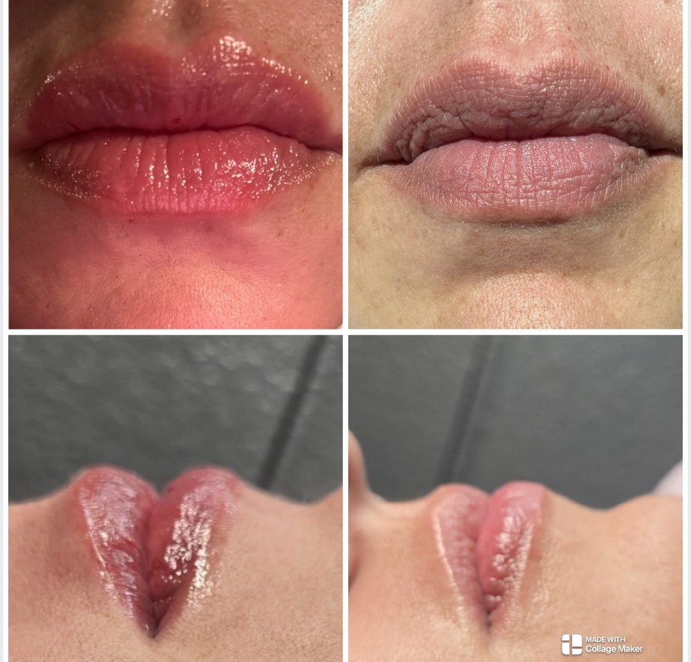 Hyaluron Lip Filler đź’‹