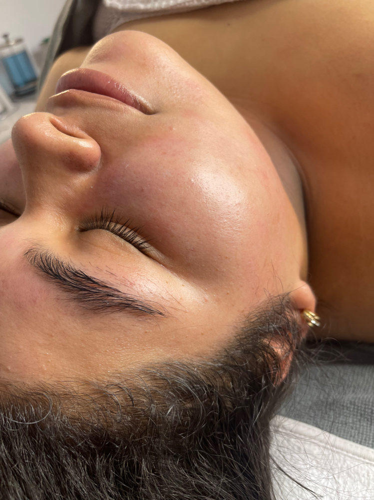 Dermaplane Facial