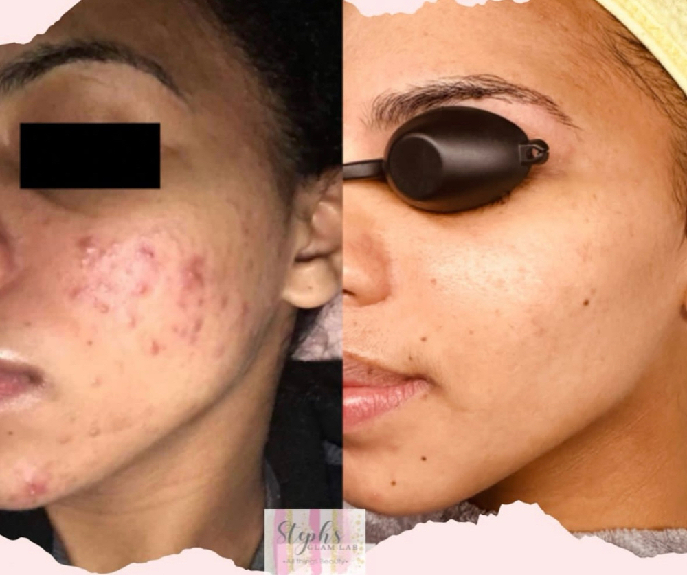 Acne Facial With Extractions